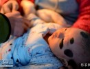女婴患巨型兽皮痣